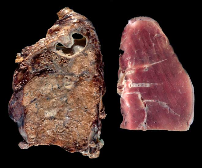 symptoms of silicosis